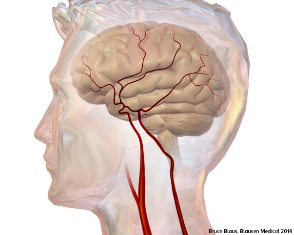如何檢查腦血管阻塞？