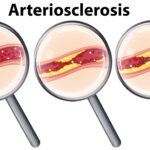 動脈硬化 會恢復嗎？