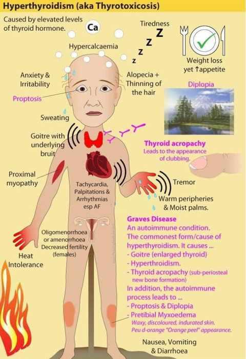 甲狀腺亢進吃藥一定會變胖嗎？