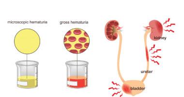 血尿怎麼改善？